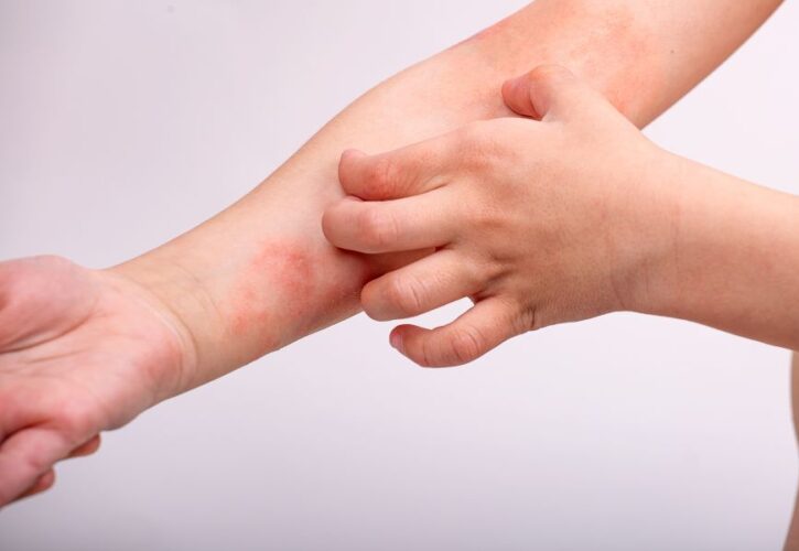 Dermatitis atópica: como sobrellevarla sin dejarte un pastón en medicamentos con una lista de contraindicaciones más larga que un día sin pan