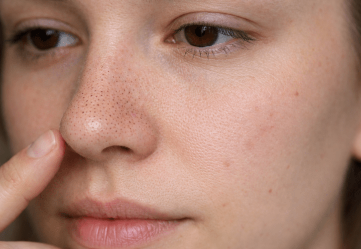 Puntos negros en la cara: qué son, por qué salen y cómo decirles adiós de forma natural